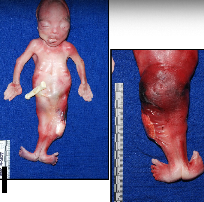 <p>“mermaid syndrome”</p>