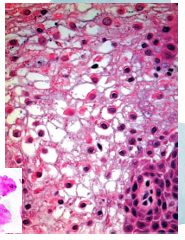 <p>-acanthosis (thickened epithelium)</p><p>-parakeratosis (thickened parakeratin)</p><p>-intracellular edema in spinous layer</p><p>-perinuclear eosinophilic condensation in superficial cells (tonofilaments of mutated keratins)</p>