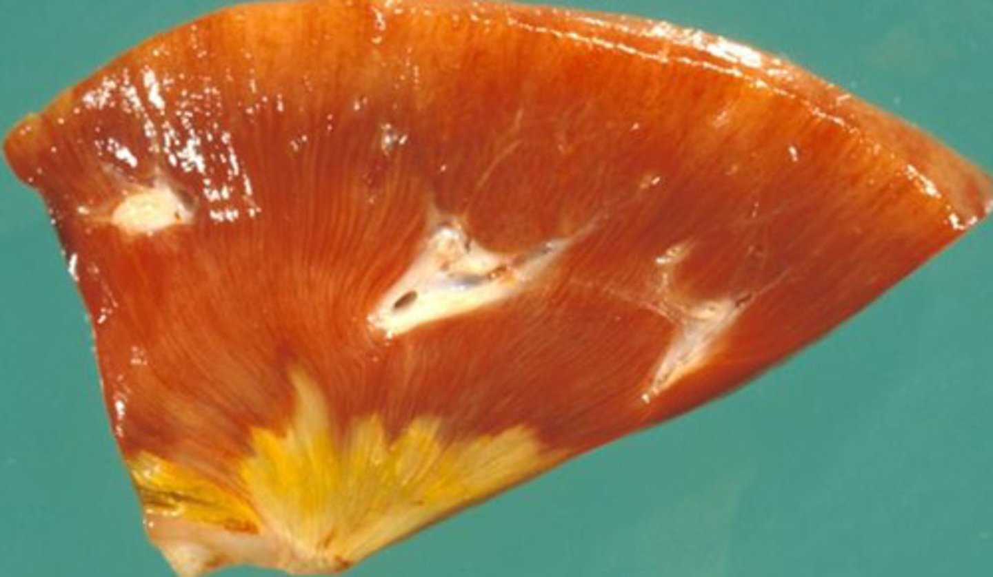 <p>What kind of necrosis is shown?</p>