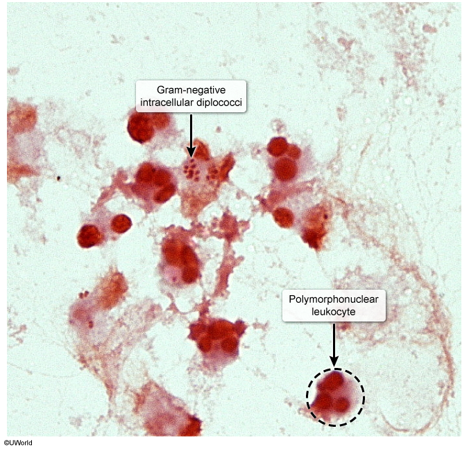 <p><mark data-color="blue">Gram-negative diplococci </mark>that metabolize glucose and produce IgA proteases. Contain lipooligosaccharides (LOS) with strong endotoxin activity. No polysaccharide capsule, no maltose acid detection. Often intracellular, sexually or perinatally transmitted. Causes gonorrhea, septic arthritis, neonatal conjunctivitis, pelvic inflammatory disease (PID), and Fitz-Hugh-Curtis syndrome. Disseminated disease present with the triad of <mark data-color="blue">polyarthralgia, tenosynovitis, and dermatitis or purulent arthritis.</mark> Diagnosis: NAAT, <mark data-color="blue">chocolate agar.</mark> Treatment: Single dose IM ceftriaxone, if coinfection with chlamidial add doxycycline.</p>