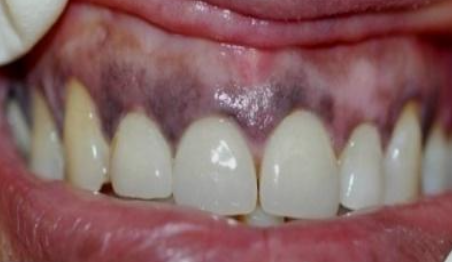 <p>AZT pigmentation</p>