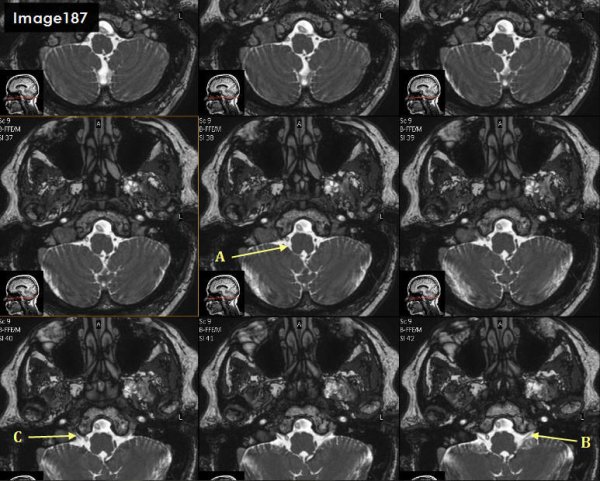 <p>Letter B in Image 187 is pointing to which cranial nerve?</p>