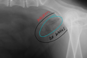 <ul><li><p><strong><u>Cannot evaluate urinary bladder wall thickness or what is within the bladder</u></strong></p><ul><li><p>silhouetting</p></li></ul></li><li><p><strong>Normal variation</strong></p></li><li><p><strong>Cystic Calculi: US</strong></p><ul><li><p>Opaque: Oxalate</p><ul><li><p>rough/smooth</p></li></ul></li><li><p>Mix: Xanthine, Struvite(smooth)</p></li><li><p>radiol<strong><u>uc</u></strong>ent: <strong><u>U</u></strong>rate / ammonium biurate, <strong><u>C</u></strong>ysteine</p></li></ul></li><li><p><strong>Cystitis</strong></p><ul><li><p><u>looks normal</u></p></li><li><p>Emphysematous: air bubbles in bladder</p></li></ul></li><li><p><strong>Obstruction</strong></p><ul><li><p><strong>Mass</strong> in<strong> trigone</strong></p></li><li><p><strong>Stone</strong> in<strong> urethra</strong></p><ul><li><p><strong>Tom Cats</strong></p></li><li><p><u>ALWAYS get a “</u><strong><u>butt shot</u></strong><u>” on all male dogs with UT </u>dx</p></li></ul></li></ul></li><li><p><strong>Rupture</strong></p><ul><li><p><u>May</u> still look distended</p></li><li><p><strong>Lack</strong> of serosal <strong>detail</strong></p></li><li><p>Sample fluid for creatinine</p></li><li><p><strong><u>Positive contrast or US to confirm</u></strong> </p></li></ul></li><li><p><strong>Neoplasia</strong></p><ul><li><p>xray<strong> look normal</strong></p></li><li><p><strong><u>Transitional cell carcinoma: need US</u></strong></p><ul><li><p>common,<strong> aggressive</strong></p></li><li><p>90% <strong>dorsal trigone</strong></p></li></ul></li><li><p><strong>Botryoid rhabdomyosarcoma</strong></p><ul><li><p>Very<strong> rare</strong></p></li><li><p>looks like <strong>grapes</strong></p></li></ul></li><li><p><strong>Leiomyosarcoma/leiomyoma/spindle cell tumors</strong></p><ul><li><p><strong>apex</strong></p></li><li><p><strong>good</strong> prognosis</p></li></ul></li></ul></li></ul><p></p>