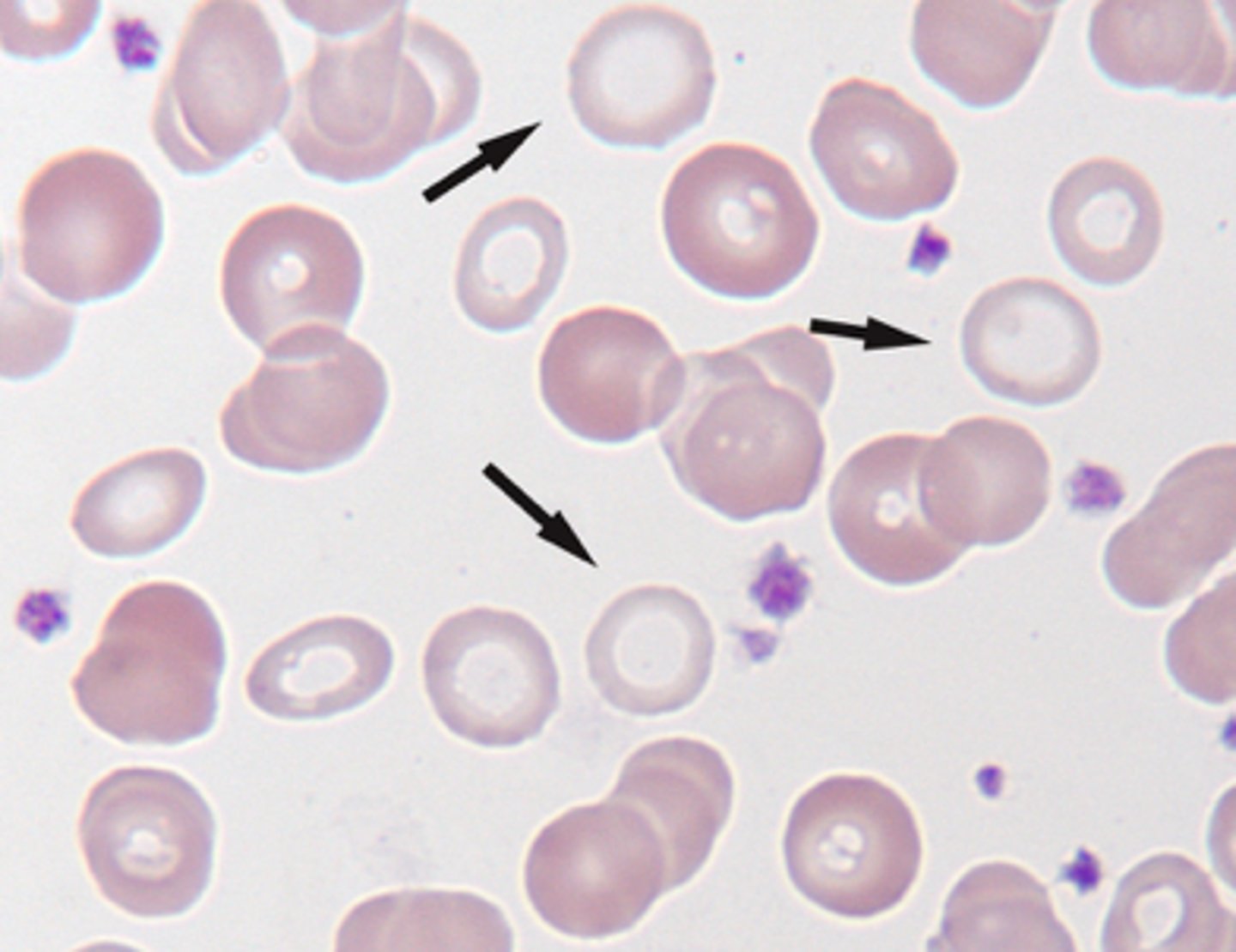 <p>B. Hypochromasia</p>