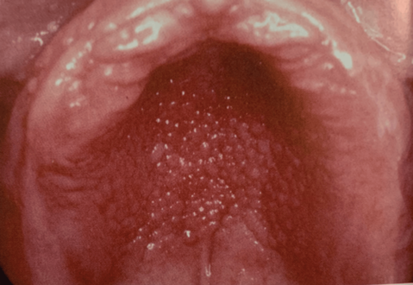 <p>• Reactive tissue growth related to</p><p>• An ill-fitting denture</p><p>• Poor denture hygiene</p><p>• 24-hour denture wearing</p>