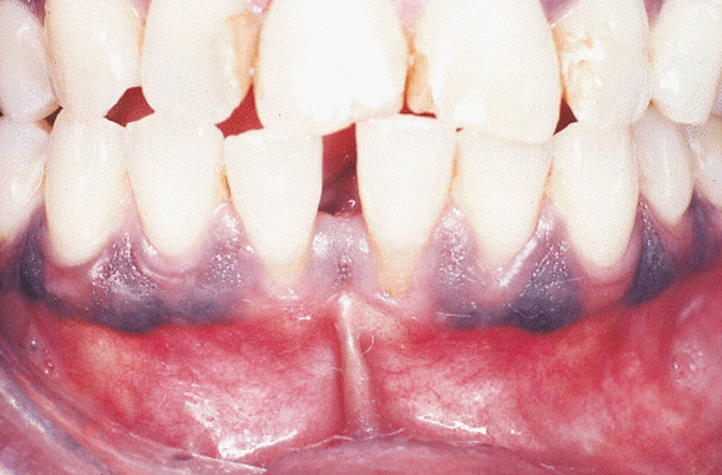 <p>The variant of normal coloration seen on the mandibular gingival surface is termed</p><p>A.lingual varicosities.</p><p>B.leukoedema.</p><p>C.melanin pigmentation.</p><p>D.linea alba.</p>