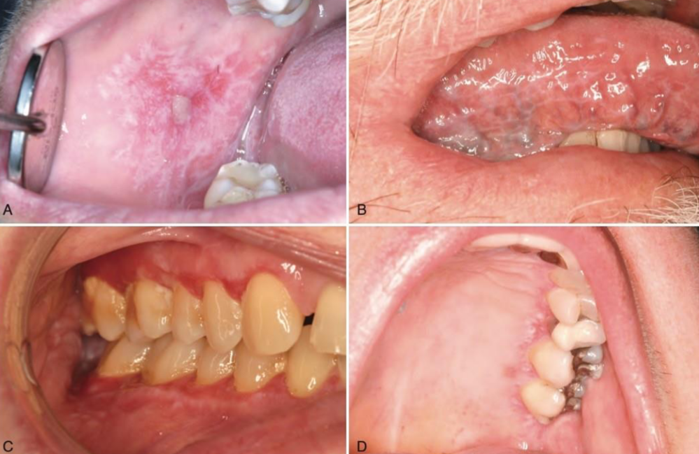 <p>which autoimmune/immune-mediated/allergic lesion: A-ulcers D-desquamative gingivitis and reticulations around erythema</p>