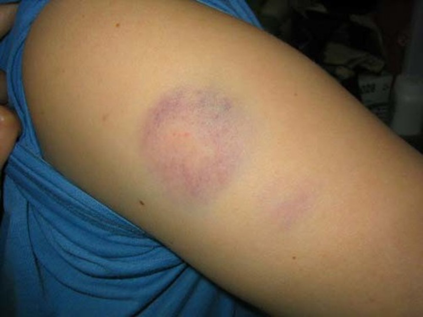<p>bruise (blood under skin)</p>