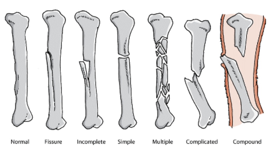 <ol><li><p>Linear fracture - parallel to bone`s long axis</p></li><li><p>Transverse - at right angle to axis</p></li><li><p>oblique - diagonal</p></li><li><p>spiral - min. one part of bone is twisted</p></li></ol><p><strong>fragments: </strong></p><ol><li><p>incomplete - bone fragments are partially joined </p></li><li><p>complete </p></li><li><p>comminuted - bone has been broken into several pieces</p></li></ol><p></p>