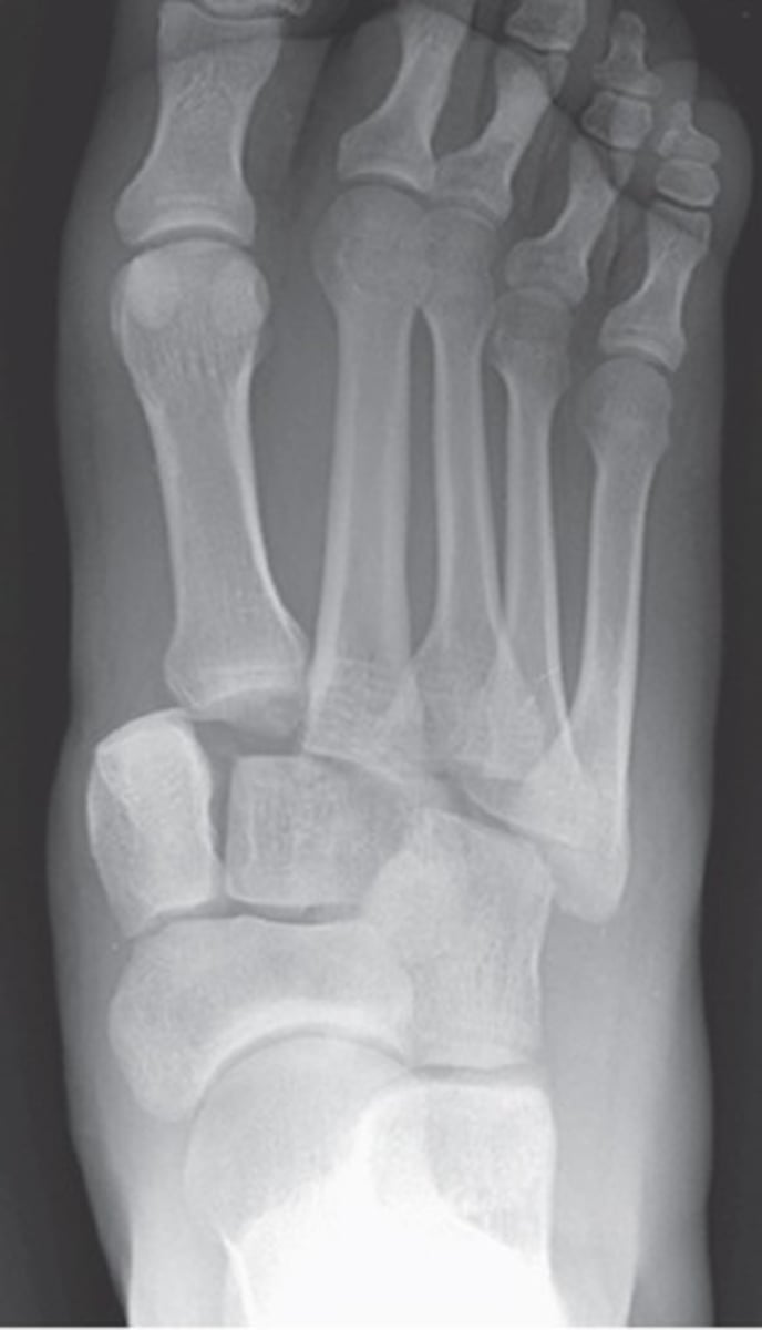<p><strong>_____________</strong> – fx of 2nd, 3rd, 4th and 5th MT with lateral dislocation</p><p></p><p>o MOI – foot caught in stirrup</p>