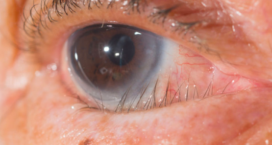 <ul><li><p>associated with <strong>stratified columnar epithelium</strong></p></li><li><p>chronic contagious conjunctivitis characterized by inflammatory granulation on the epithelium surface caused by <strong>Chlamydia Trachomatis</strong></p></li><li><p>eyelash deformities</p></li></ul><p></p>