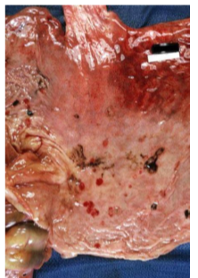 <ul><li><p>stomach compartment 3 (Equivalent to the monogastric stomach) is most commonly affected</p><ul><li><p>Etiology: stress factors </p><ul><li><p>environmental changes </p></li><li><p>social changes </p></li><li><p>disease </p></li><li><p>hospiralizaiton </p></li></ul></li><li><p>clinical signs: </p><ul><li><p>Bruxism<span style="color: red"> (<strong>teeth grinding) </strong></span></p></li><li><p>ptyalism </p></li><li><p>anorexia </p></li><li><p>regurgtation </p></li><li><p>black feces </p></li><li><p>recumbency </p></li></ul></li><li><p>Diagnosis: </p><ul><li><p>clinical signs</p></li><li><p>history of stress </p></li><li><p>U/S thickening and edema of C3 wall </p></li></ul></li><li><p>treatment </p><ul><li><p>remove stressor </p></li><li><p>gastric protectants (sucralfate) </p></li><li><p>H2 receptor antagonist (ranitidine, cimetidine, famotidine) </p></li><li><p>proton pump inhibitors (pantoprazole) </p></li></ul></li></ul></li></ul><p></p>