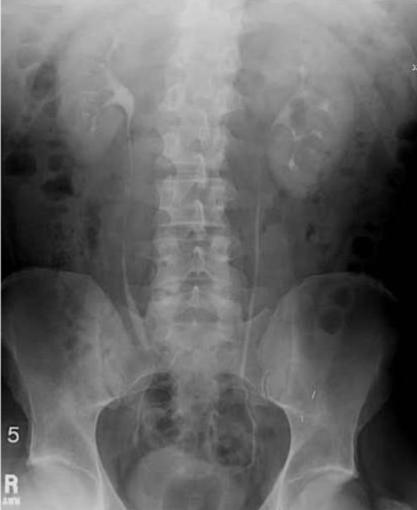 <p>(where do kidney stones tend to get stuck most often?)</p>