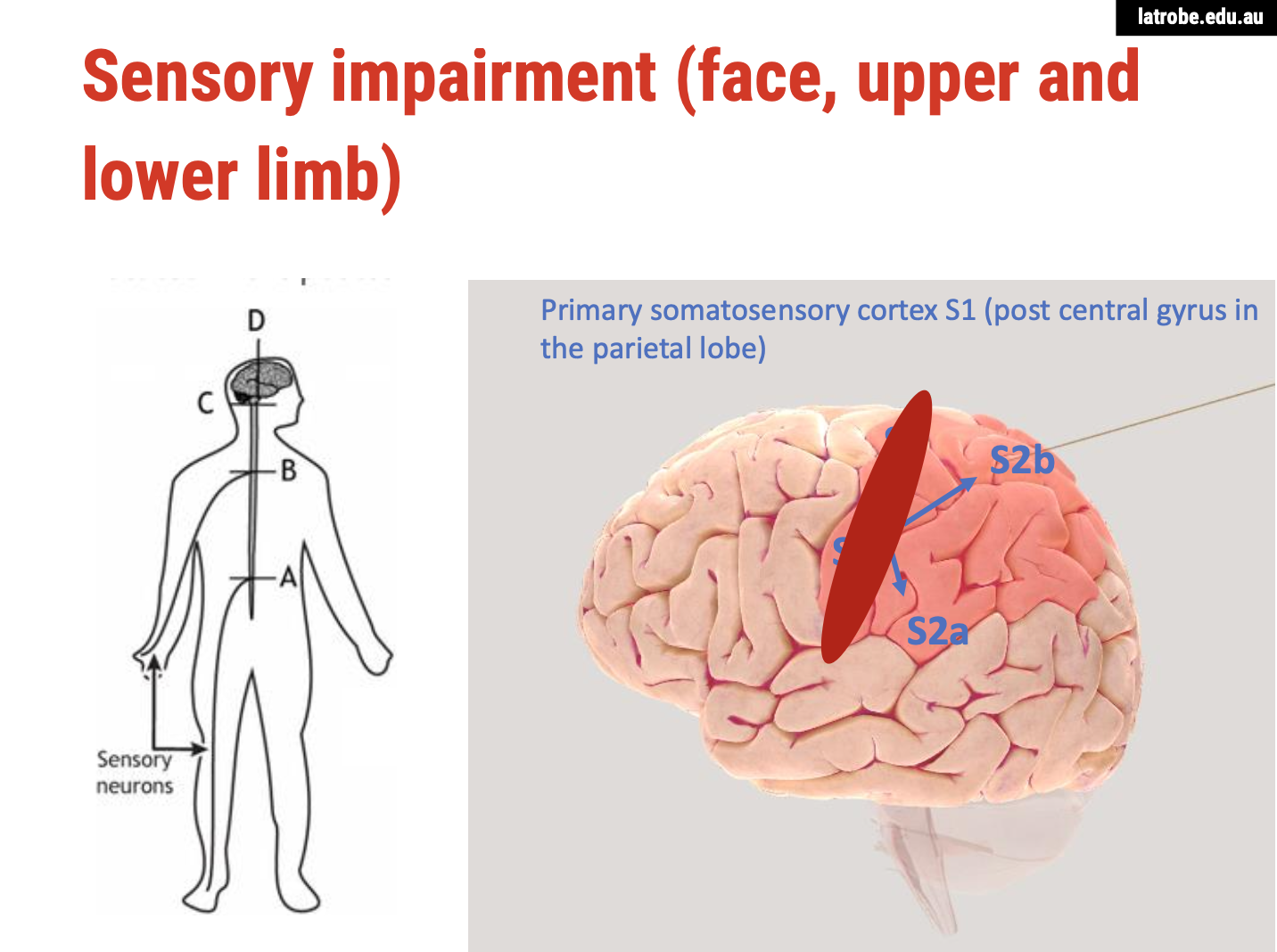 <p><span><strong>Impact of Damage to the Postcentral Gyrus (S1)</strong></span></p><p><span><strong>Overview of Sensory Impairment</strong></span></p><ul><li><p><span><strong>Sensory Impairment</strong>: Damage to the postcentral gyrus, or primary somatosensory cortex (S1), leads to&nbsp;<strong>broad sensory impairments</strong>&nbsp;in the affected areas of the body.</span></p></li><li><p><span><strong>Affected Areas</strong>: Depending on the location of the damage within S1, the impairment may affect:</span></p><ul><li><p><span><strong>Face</strong></span></p></li><li><p><span><strong>Arm</strong></span></p></li><li><p><span><strong>Leg</strong></span></p></li><li><p><span><strong>Potentially all these areas</strong>&nbsp;if the damage is extensive.</span></p></li></ul></li></ul><p><span><strong>Consequences of Damage</strong></span></p><ol type="1"><li><p><span><strong>Inability to Register Sensation:</strong></span></p><ul><li><p><span><strong>Individuals may&nbsp;lack awareness&nbsp;of tactile stimuli. For example, if someone touches their arm while their eyes are closed, they will not feel it.</strong></span></p></li></ul></li><li><p><span><strong>Functionality of Sensory Pathways:</strong></span></p><ul><li><p><span><strong>While&nbsp;sensory receptors&nbsp;in the skin and the&nbsp;nerves&nbsp;transmitting signals to the brain (through the midbrain and thalamus) are functioning normally, the damage to S1 prevents the brain from processing these signals.</strong></span></p></li></ul></li><li><p><span><strong>Perception of Touch:</strong></span></p><ul><li><p><span><strong>The inability to register sensations means that the individual is&nbsp;effectively unable to feel anything. This can lead to complications in everyday activities and a lack of awareness of potential injuries.</strong></span></p></li></ul></li></ol><p><span><strong>Conclusion</strong></span></p><p>Damage to the primary somatosensory cortex results in significant challenges for individuals, including an inability to perceive touch and sensory information. This lack of awareness can affect their safety, mobility, and overall quality of life, as they cannot respond appropriately to tactile stimuli or recognize bodily sensations.</p>