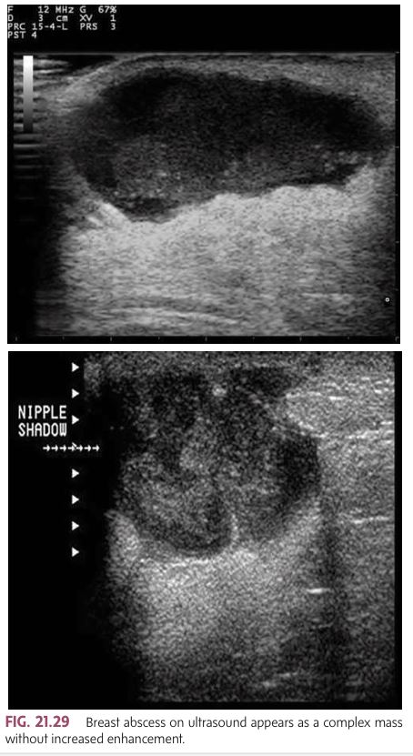 <p>Because obstructed ducts are prone to infection, acute mastitis can develop into a ______</p><ul><li><p class=""><strong>Cause</strong>: Bacteria entering through cracked nipples or skin wounds, leading to infection.</p></li><li><p class=""><strong><mark data-color="yellow" style="background-color: yellow; color: inherit">most often found in the subareolar area.</mark></strong></p></li><li><p class=""><strong>Symptoms</strong>:</p><ul><li><p class="">Pain, swelling, redness, and possibly fever.</p></li><li><p class="">Swollen, painful <strong>axillary nodes</strong>.</p></li></ul></li><li><p class=""><strong>Sonographic Features</strong>:</p><ul><li><p class=""><strong>Acute abscesses</strong>: Poorly defined borders.</p></li><li><p class=""><strong>Mature abscesses</strong>: Well encapsulated with sharp borders.</p></li><li><p class=""><strong>Ultrasound</strong>: Diffuse, mottled breast appearance, irregular margins, posterior enhancement, and low-level internal echoes.</p></li><li><p class=""><strong>If associated with mastitis, </strong>skin thickening is almost always present, and edema leads to diffusely increased echogenicity of the breast tissue. </p></li><li><p class=""><strong>Doppler imaging</strong>: Can show increased vascularity (hyperemia), which helps distinguish an abscess from other lesions like hematomas.</p></li></ul></li></ul><p></p>