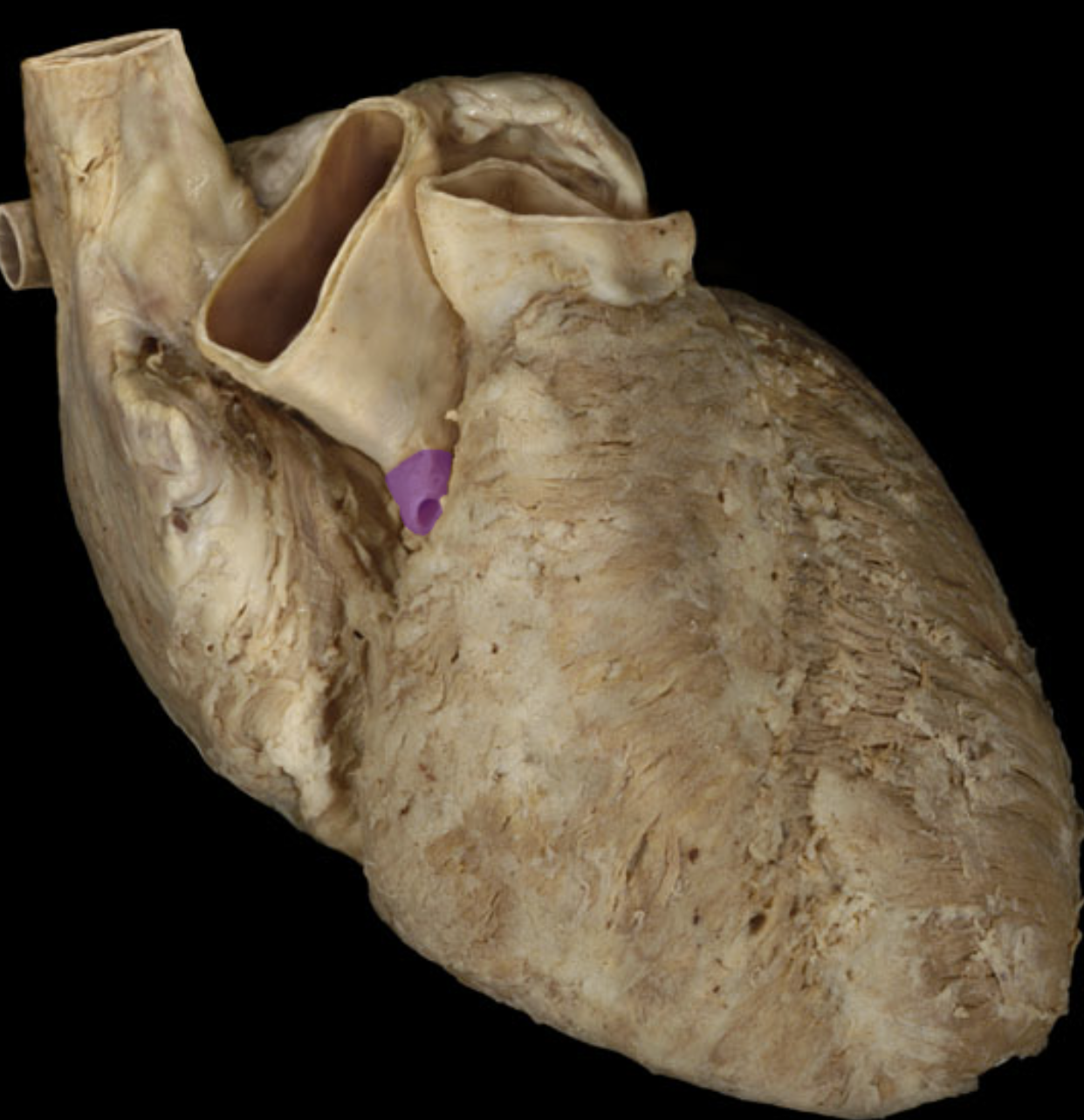 <p>Right coronary a.</p>