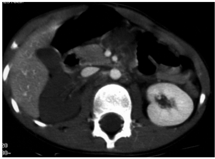 <p>What does this CT image show?</p>