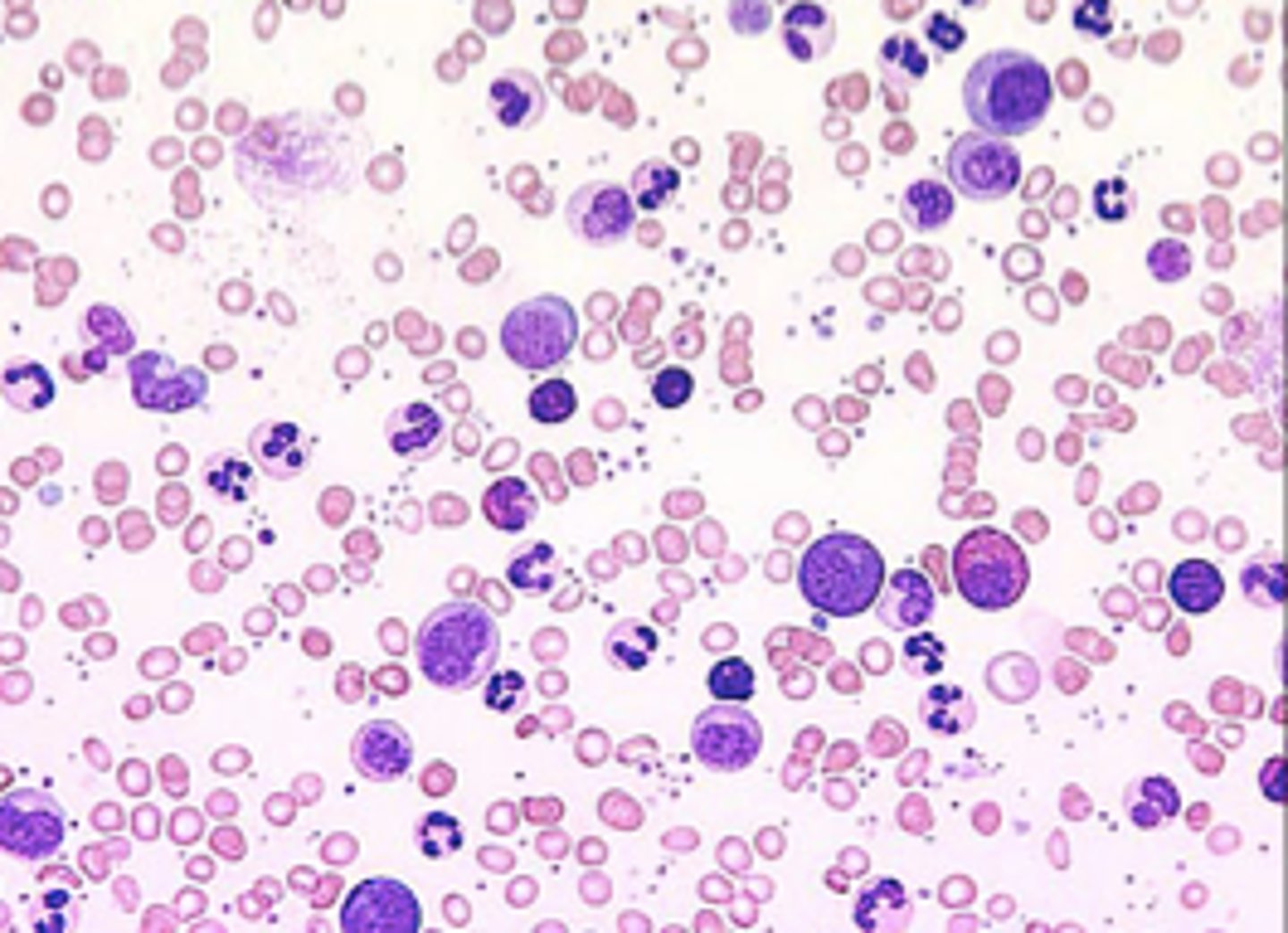 <p>abnormal increase in granulocytes in the blood</p>