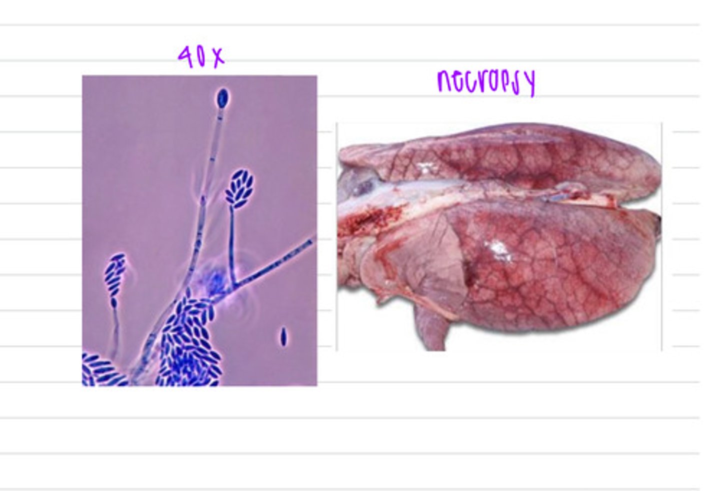 <p>a farmer brings in one of his pigs that has died. he says that the day before his death, he noticed the pig started to have trouble breathing, was weak, her mouth was turning blue, and she didn't want to stand up. the vet suspects a certain disease so takes out the pig's lungs to observe them and confirm his diagnosis because he sees interstitial pulmonary edema.</p><p>what is the diagnosis?</p>