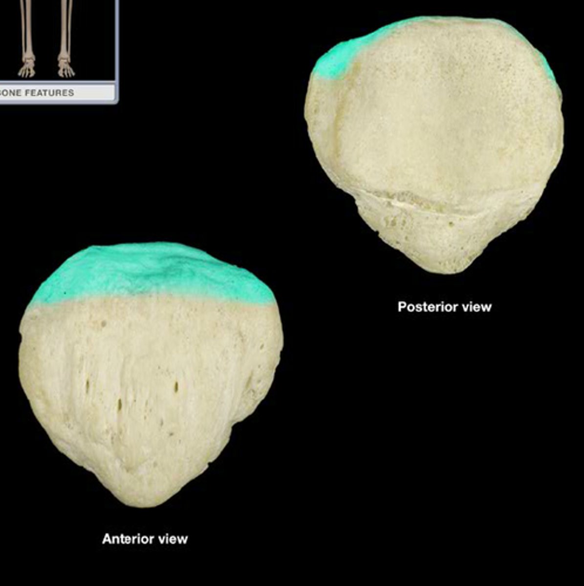 <p>Base of the patella</p>