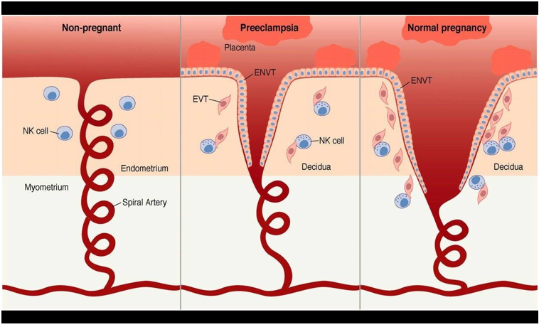 <p>Due to smaller cleft it is poorly perfused, abnormally implanted and excessively large in size</p><p>Need broad opening for pulsatile blood flow in pre-eclamptic women there is a small trickling of blood</p><p>ENVT = extravillous trophoblasts (placental cells) that grow into endometrial and myometrial layer</p><p></p>