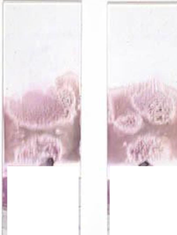 <p>What is this blood film appearance, and what is the cause/solution?</p>