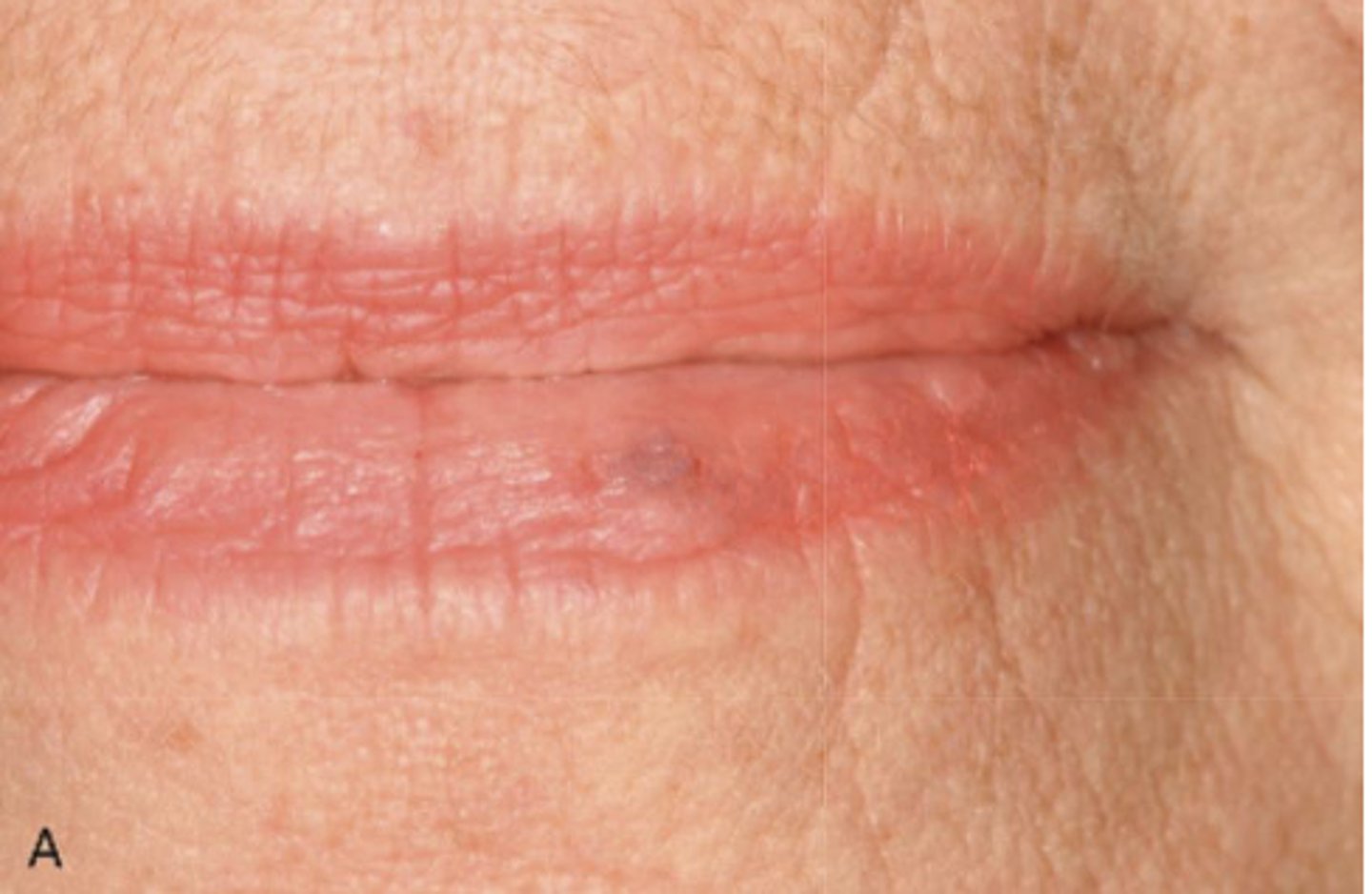 <p>What type of pigmented lesion?</p>