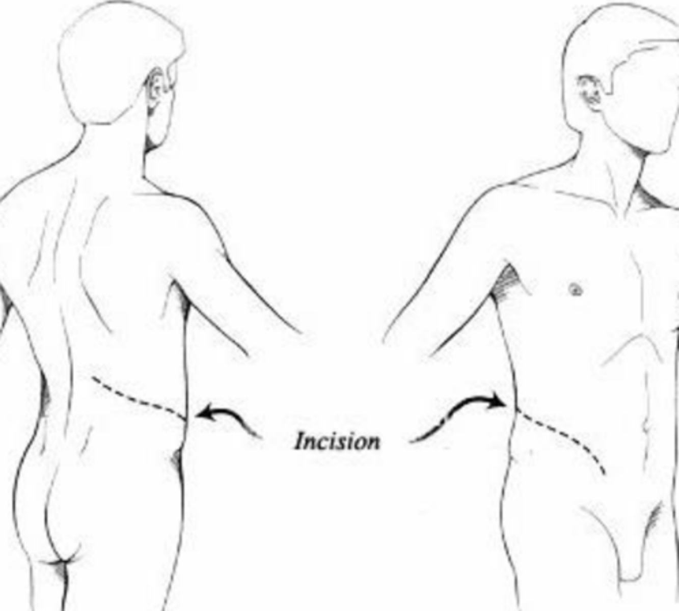 <p>what incision is this</p>