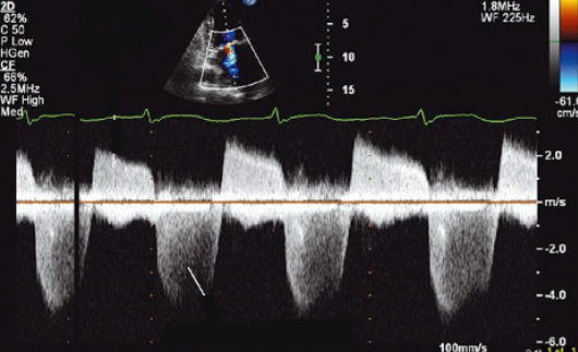 <p>Identify the spectral Doppler waveform:</p>