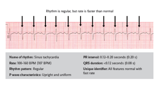 <p>a fast sinus rhythm with normal characteristics but with a rate of 100–160 BPM</p><ul><li><p>Can be caused by medications, stress, or the body’s need for additional oxygen</p></li><li><p>Fever, exercise, fear, and low blood volume can also be causes</p></li><li><p>Can be especially dangerous for patients with a history of coronary artery disease</p></li><li><p>Treatment depends on the cause</p></li></ul><p></p>