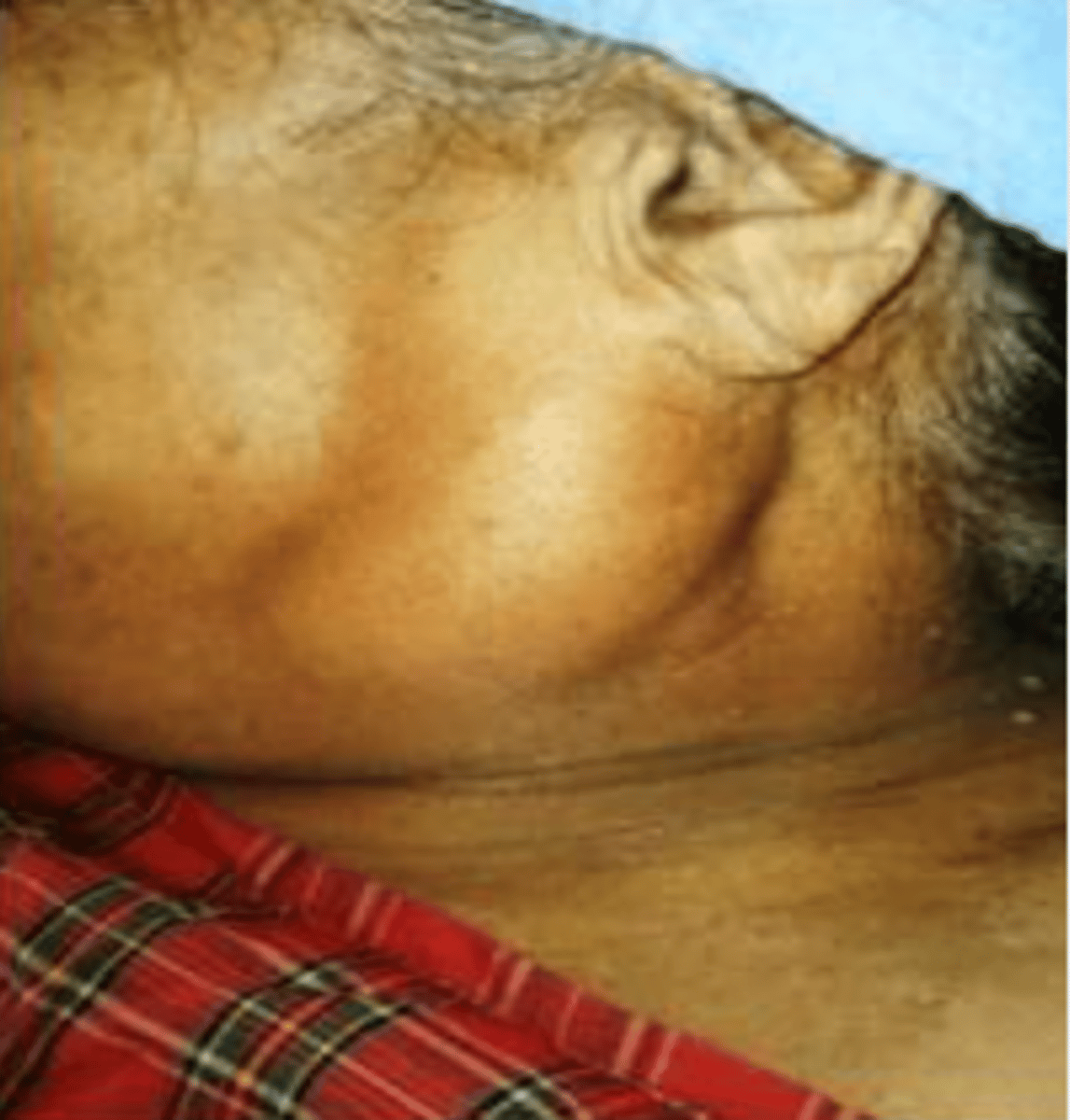 <p>Benign Salivary Gland Tumors:</p><p>• Rare salivary gland tumor</p><p>▫ Common in older</p><p>females</p><p>▫ Occurs in the parotid gland (85-90%)</p><p>▫ Presents as slow growing painless mass</p>