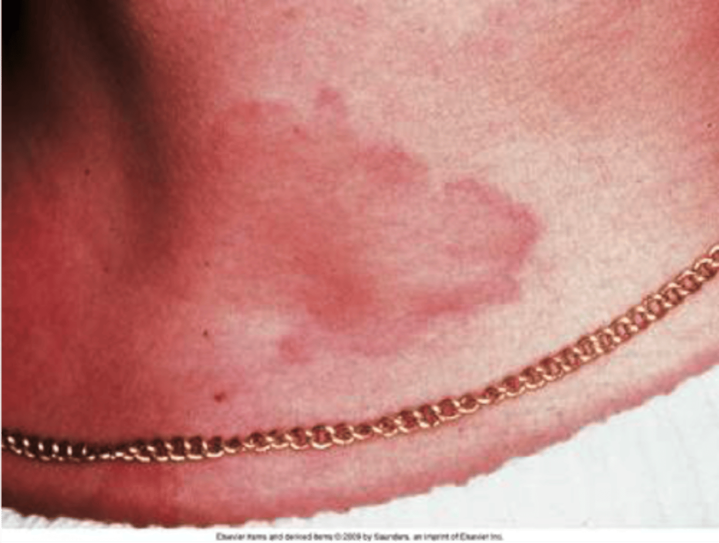 <p>Urticaria (Hives)</p>