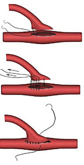 <p>What type of anastomosis is this?</p>