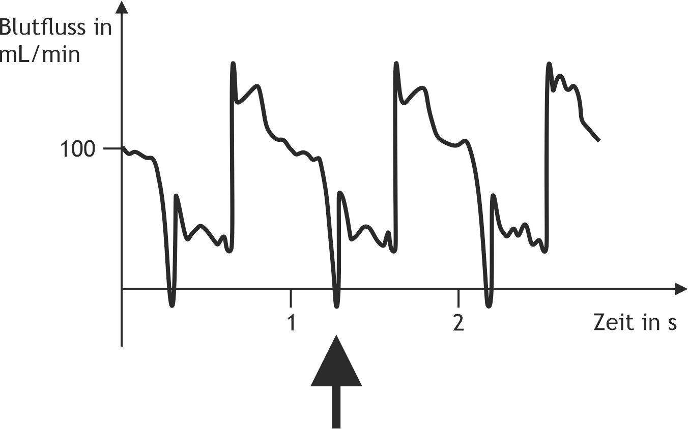 <p>41. The figure shows the time course of blood flow in a coronary artery supplying the left ventricular myocardium.</p><p>The point on the curve marked by the arrow most likely corresponds to:</p><p>A. The P wave in the ECG</p><p>B. The T wave in the ECG</p><p>C. The left ventricular isovolumetric contraction phase</p><p>D. The time of maximal systolic ventricular pressure</p><p>E. The dicrotic notch (incisura) of the aortic pressure curve</p>