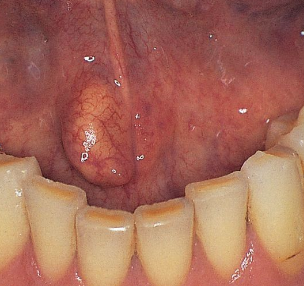 <p>What is the clinical presentation of sialolithiasis?</p>