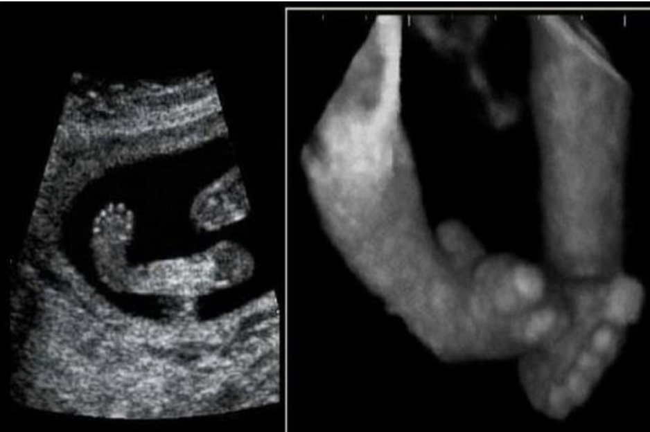 <p>what fetal anomaly is this</p><p>a) syndactyly</p><p>b) club foot</p><p>c) rocker foot bottom</p><p>d) clinodactyly</p>