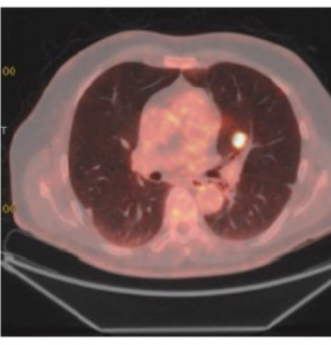 <p>lighting up on pet scan is benign or malignant?</p>
