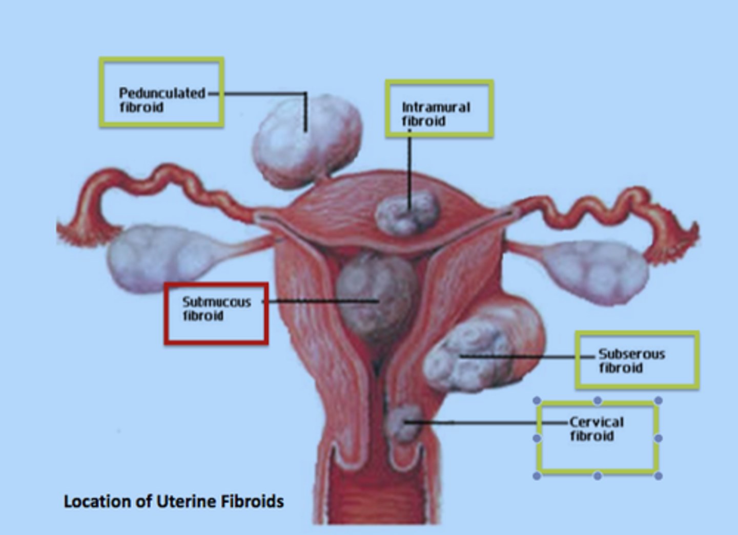 <p>submucosal, intramural, subserosal, interligamentous</p>