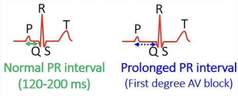 <ul><li><p><strong>1st Degree AV block</strong> → A delay in electrical conduction from the atria to the ventricles usually at the AV node</p></li><li><p><span style="color: green;">Normal = </span><span style="color: green;"><strong>0.12 - 0.20 seconds</strong></span><span style="color: green;"> </span></p></li></ul><p></p>