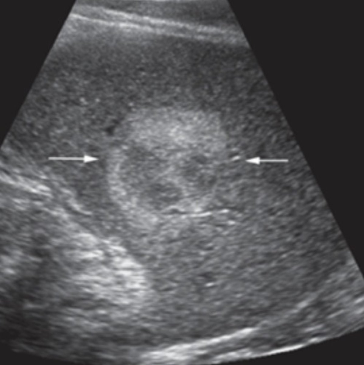 <p>Most common benign tumor of the spleen</p><p>Made of excess new blood vessels</p><p>Variable echogenicities</p><p>Similar to liver hemangiomas</p>