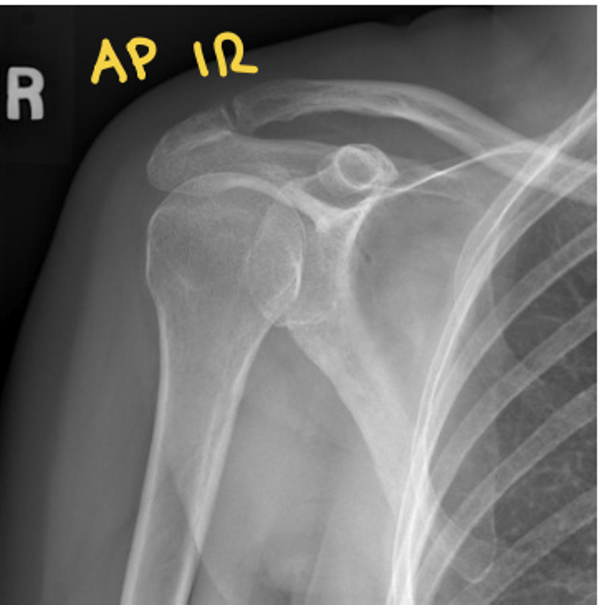 <p>see lesser tuberosity</p>