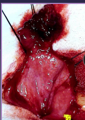 <p><span>Bladder Neoplasia</span></p>