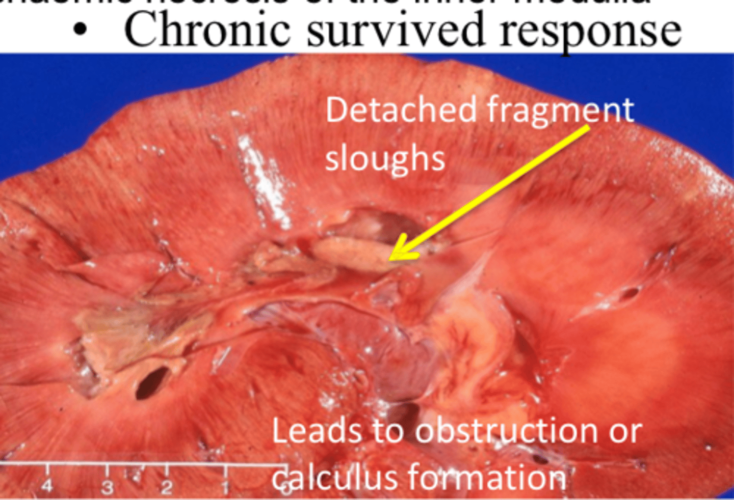 <p>Reduced vasa recta blood flow due to glomerular disease</p><p>Compression of the vasa recta by medullary interstitial disease or compression of the renal papilla</p>
