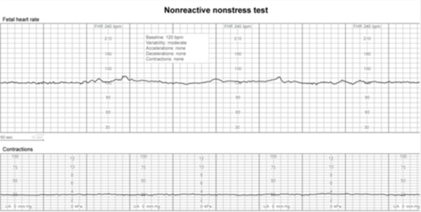 <p>quiet fetal sleep cycle, no accelerations</p><p>-can last as long as 40 minutes, extend to ensure fetal activity outside of sleep is captures</p>