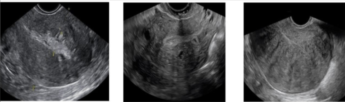 <p>which uterine abn is described as causing a <strong>swiss cheese</strong> appearance of uterus on US</p><p>a) placenta accreta</p><p>b) chorioangioma</p><p>c) choriocarcioma</p><p>d) adenomyosis</p>