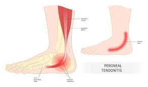 <p><span><strong>refers to the fibula bone or structures associated with it, particularly the peroneal muscles and tendons on the outer side of the lower leg and ankle</strong></span></p>