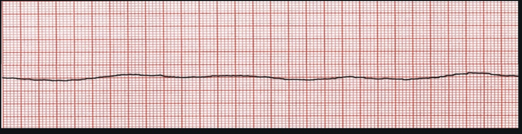 <p>ECG Interpretation</p>