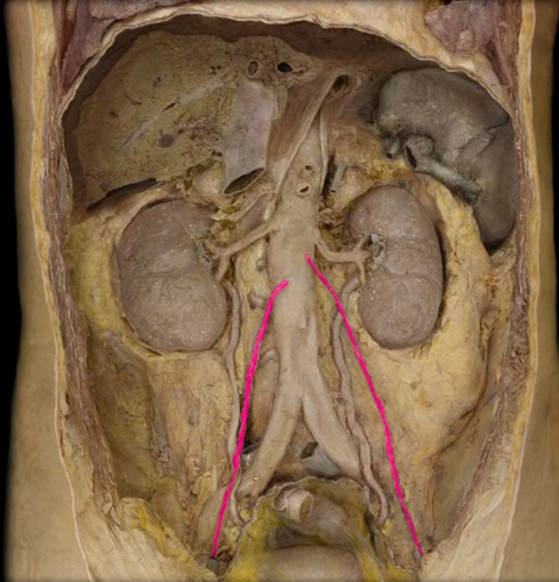 <p>ID left pink, assume pt is female</p>