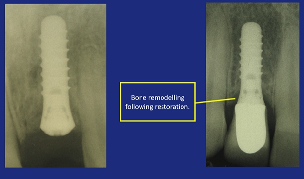 Micro-gap between the implant and the restoration