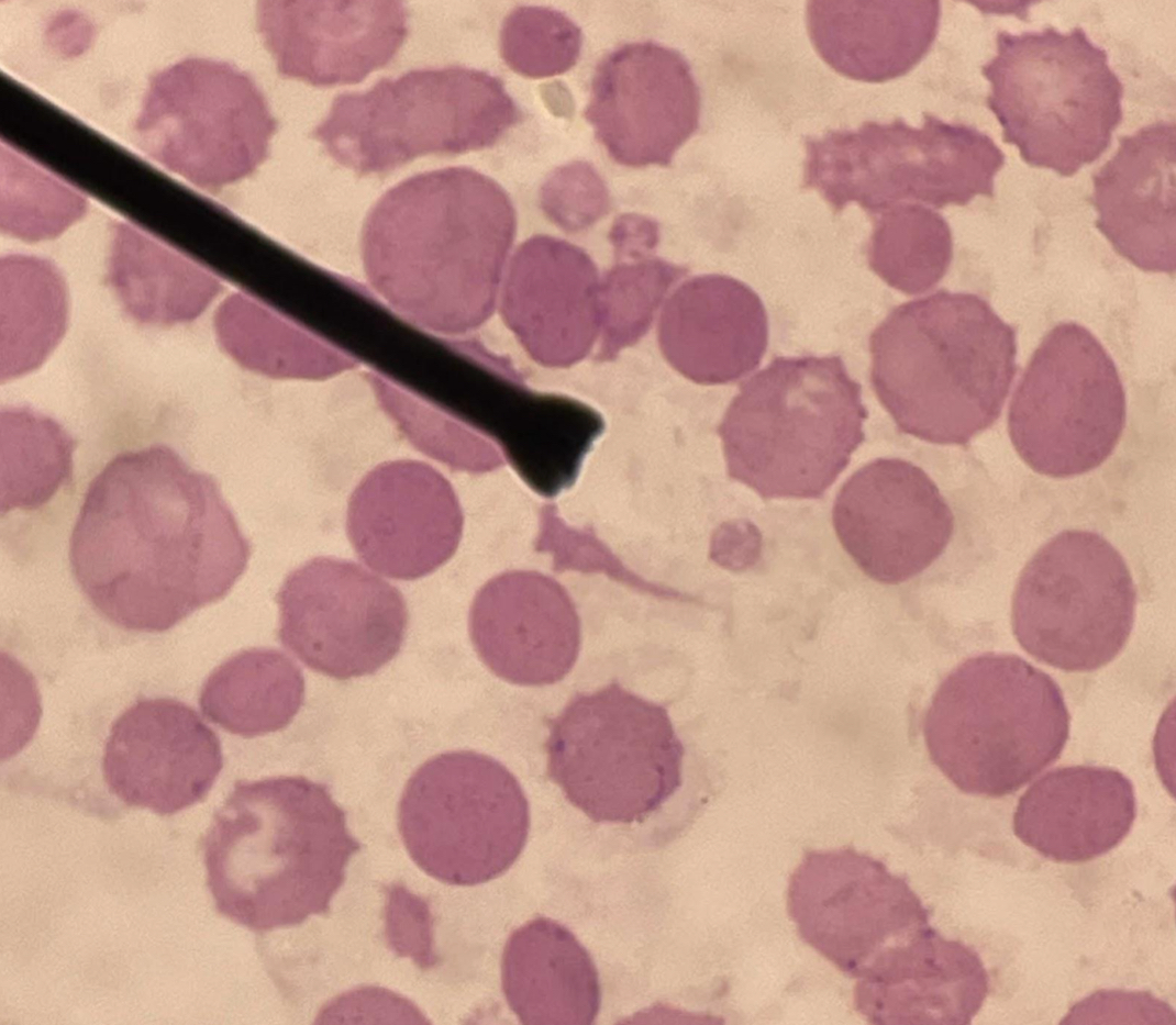 <p>A. Identify the pointed cell</p><p>B. Describe the striking feature</p><p>C. Associated with what condition?</p><p>D. what is responsible for the characteristic shape of this cell?</p><p>E. What screening tests can be done ?</p><p>F. What is the main defect of this cell?</p>